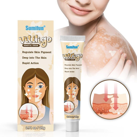 Vitiligo Cream, Vitiligo Care Cream for Skin Vitiligo, Psoriasis, Leukoplakia - Reduces White Spots