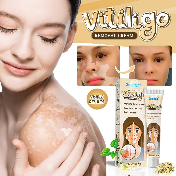 Vitiligo Cream, Vitiligo Care Cream for Skin Vitiligo, Psoriasis, Leukoplakia - Reduces White Spots